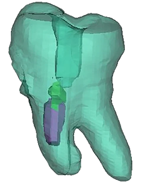 3D Endodontics — photo 2