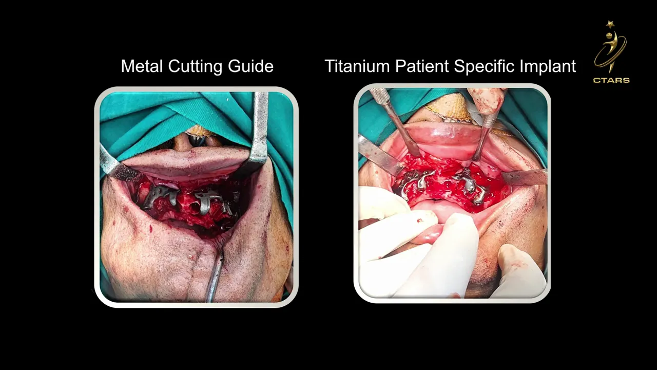 3D-printed skull model with titanium patient-specific implants for maxillo-mandibular rehabilitation