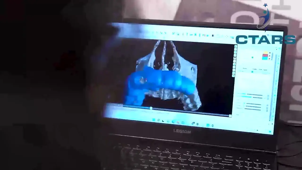 A CTARS engineer planning a reconstruction on a 3D model of the patient’s skull