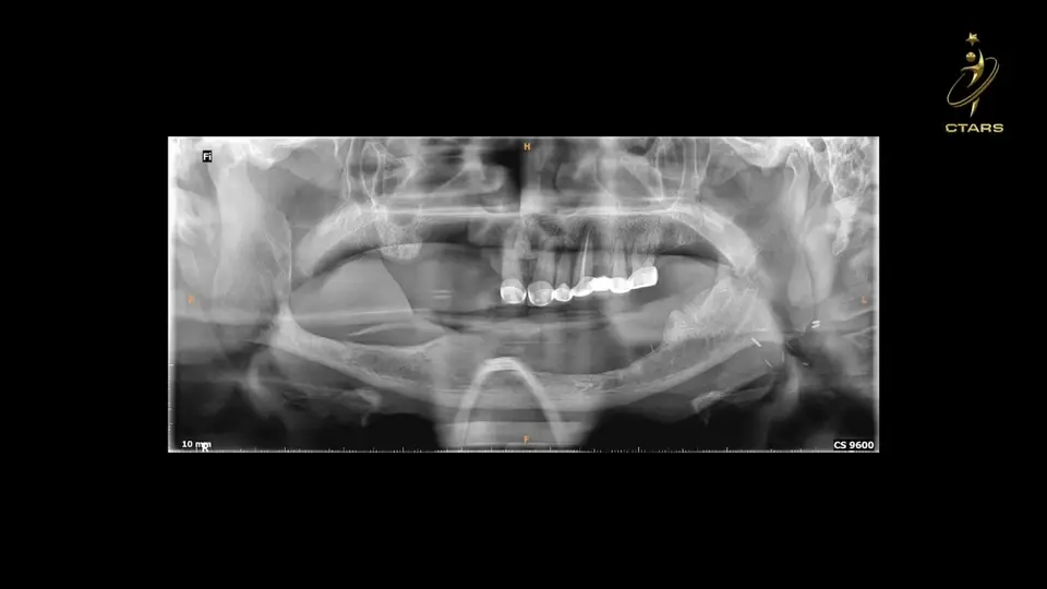 Case: atrophic maxillo-mandibular rehabilitation