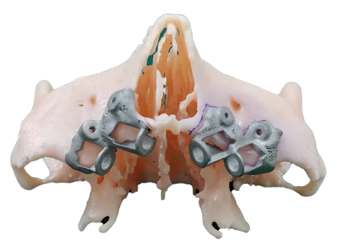 IPS — Implant Positioning System — photo 2