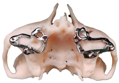 IPS — Implant Positioning System — photo 4