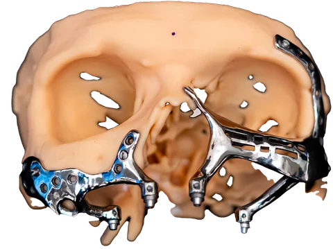 Mucormycosis (Black Fungus) Reconstruction — photo 2
