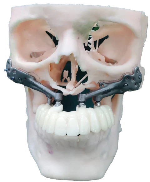Mucormycosis (Black Fungus) Reconstruction — photo 4