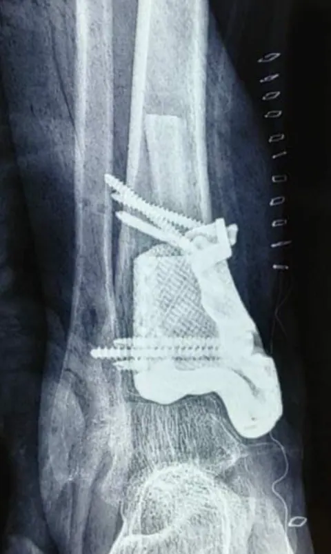 CTARS orthopaedic model — photo 8