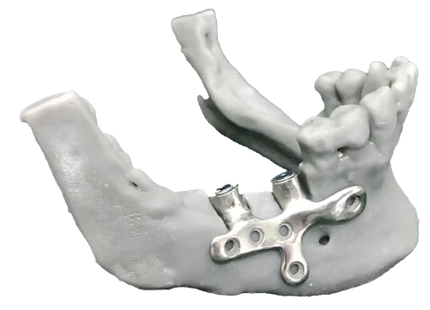 PSI — Patient Specific Implant — photo 2
