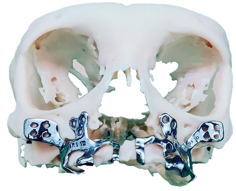 PSI — Patient Specific Implant — photo 3