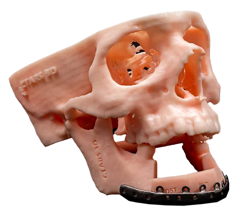 PSI — Patient Specific Implant — photo 4