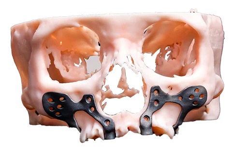 PSI — Patient Specific Implant — photo 5