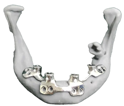 PSI — Patient Specific Implant — photo 6