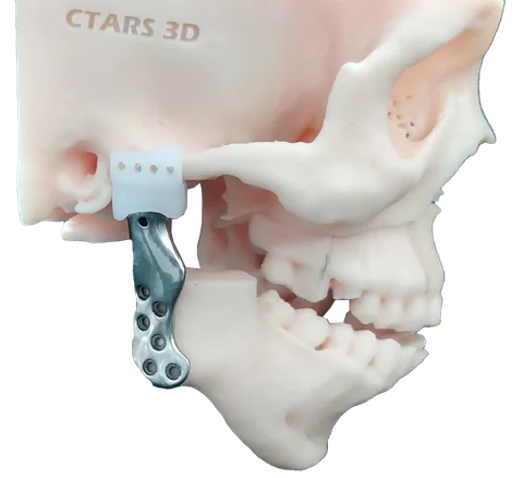 TJR — Temporomandibular Joint Reconstruction — photo 2