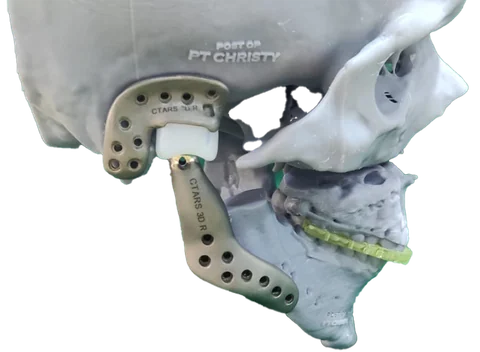 TJR — Temporomandibular Joint Reconstruction — photo 3