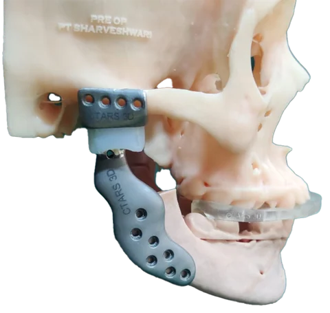 TJR — Temporomandibular Joint Reconstruction — photo 4